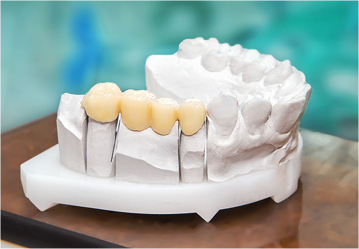 Dental model showing a restoration on bottom teeth.